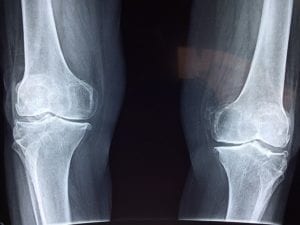 an x-ray of knees