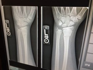 X-rays of a broken arm